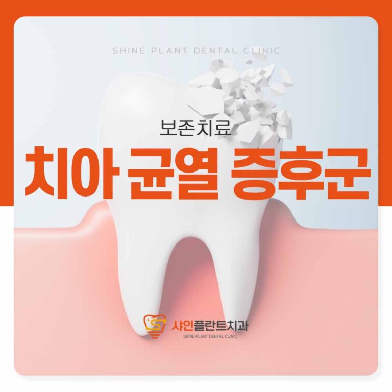 샤인플란트치과 치아 균열 증후군, 특정 치아만 찌릿하다면
