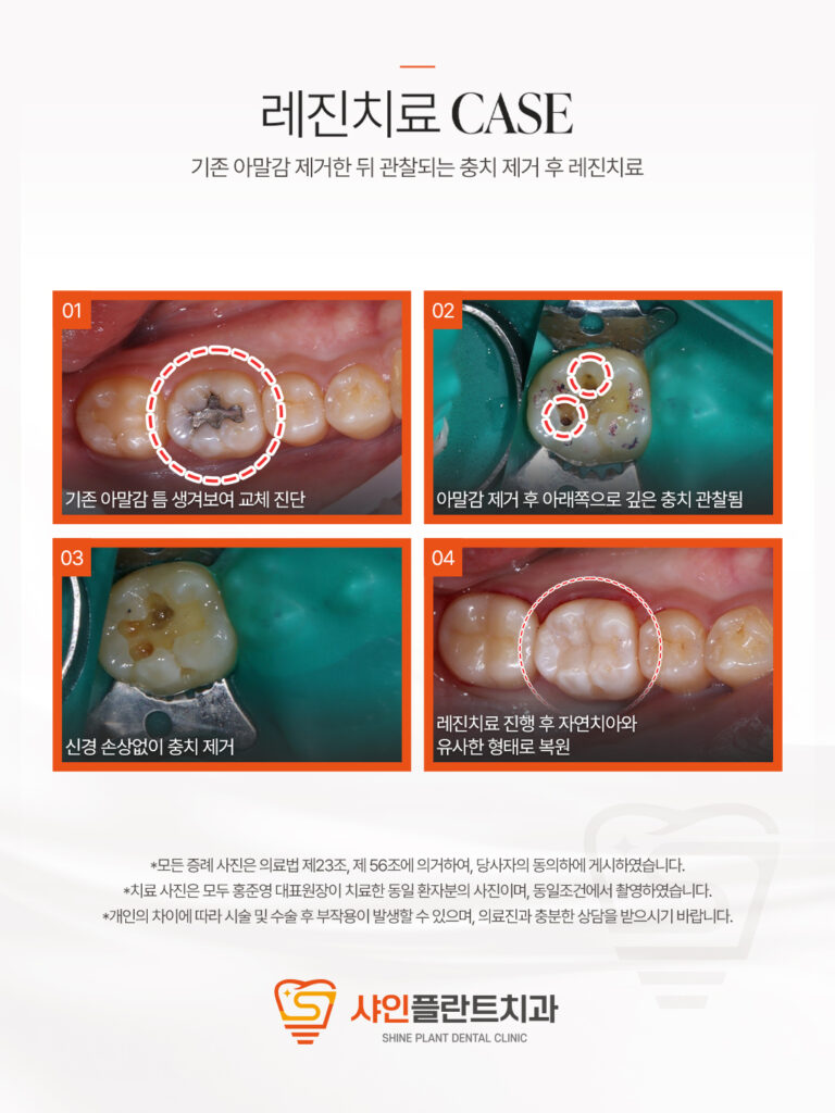 치료 사례 5