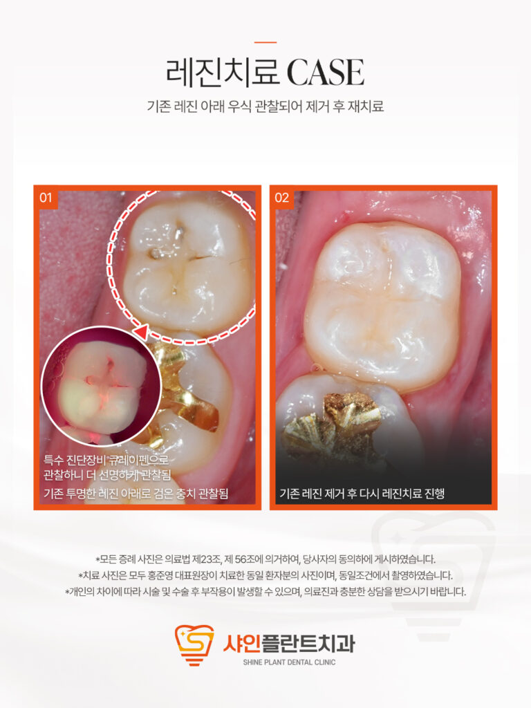 치료 사례 4
