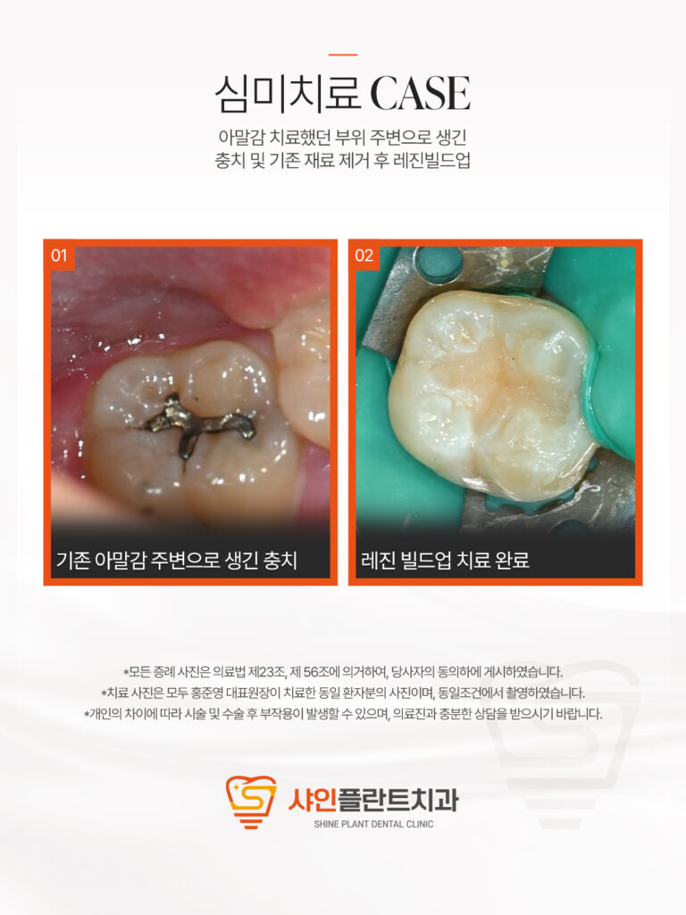 치료 사례 3